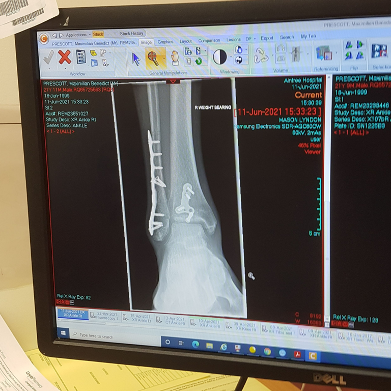 my new ankle.png